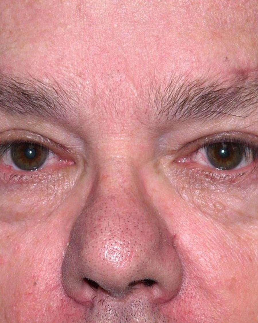 Facelift (neck lift included) after