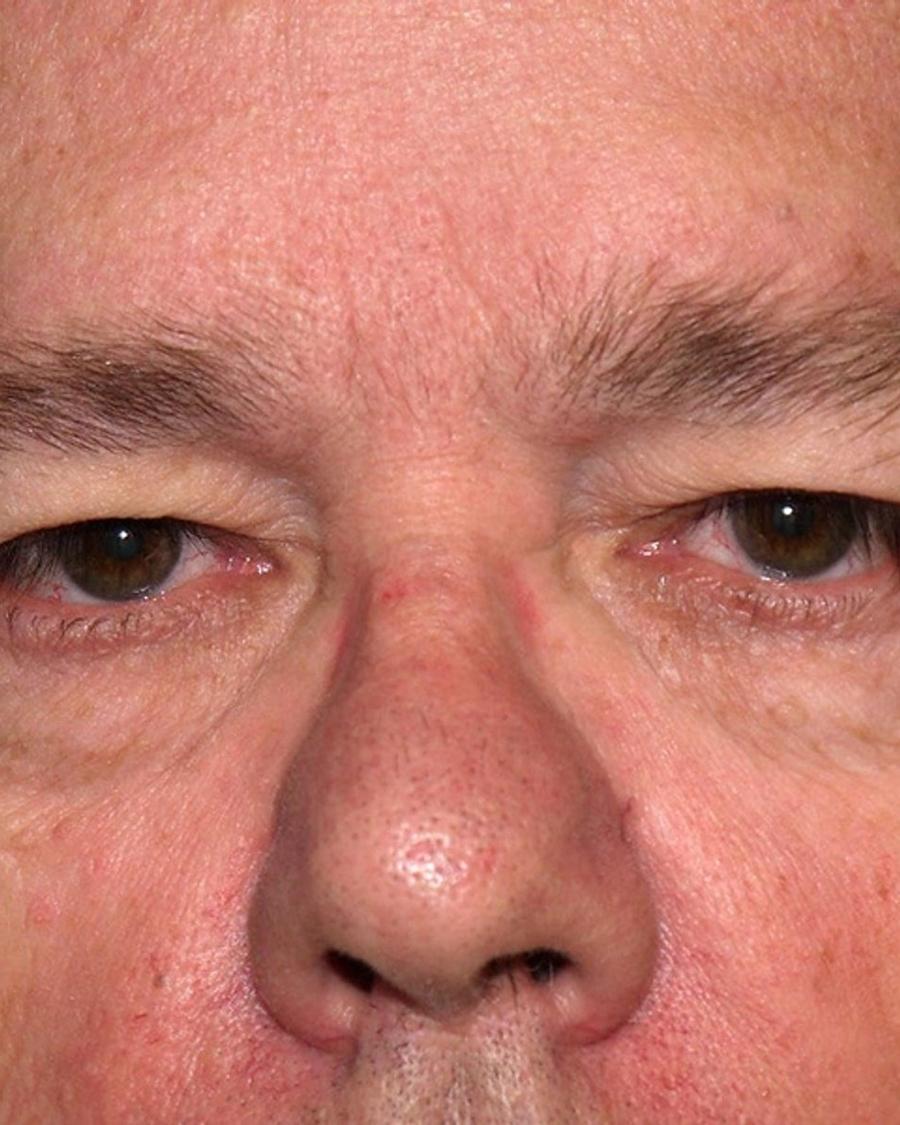 Facelift (neck lift included) before