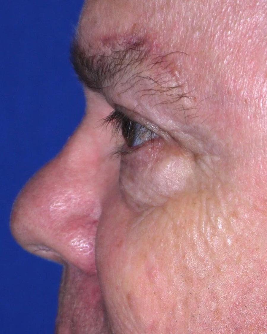 Facelift (neck lift included) after