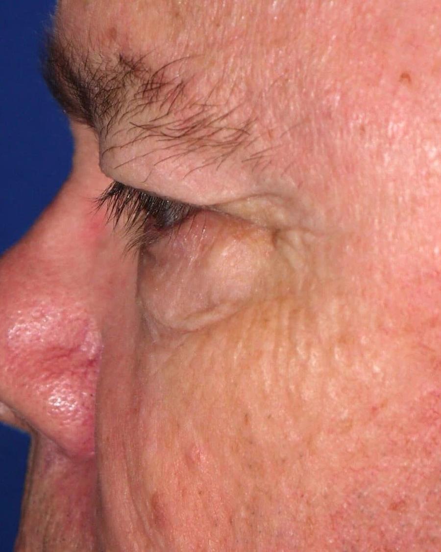 Facelift (neck lift included) before
