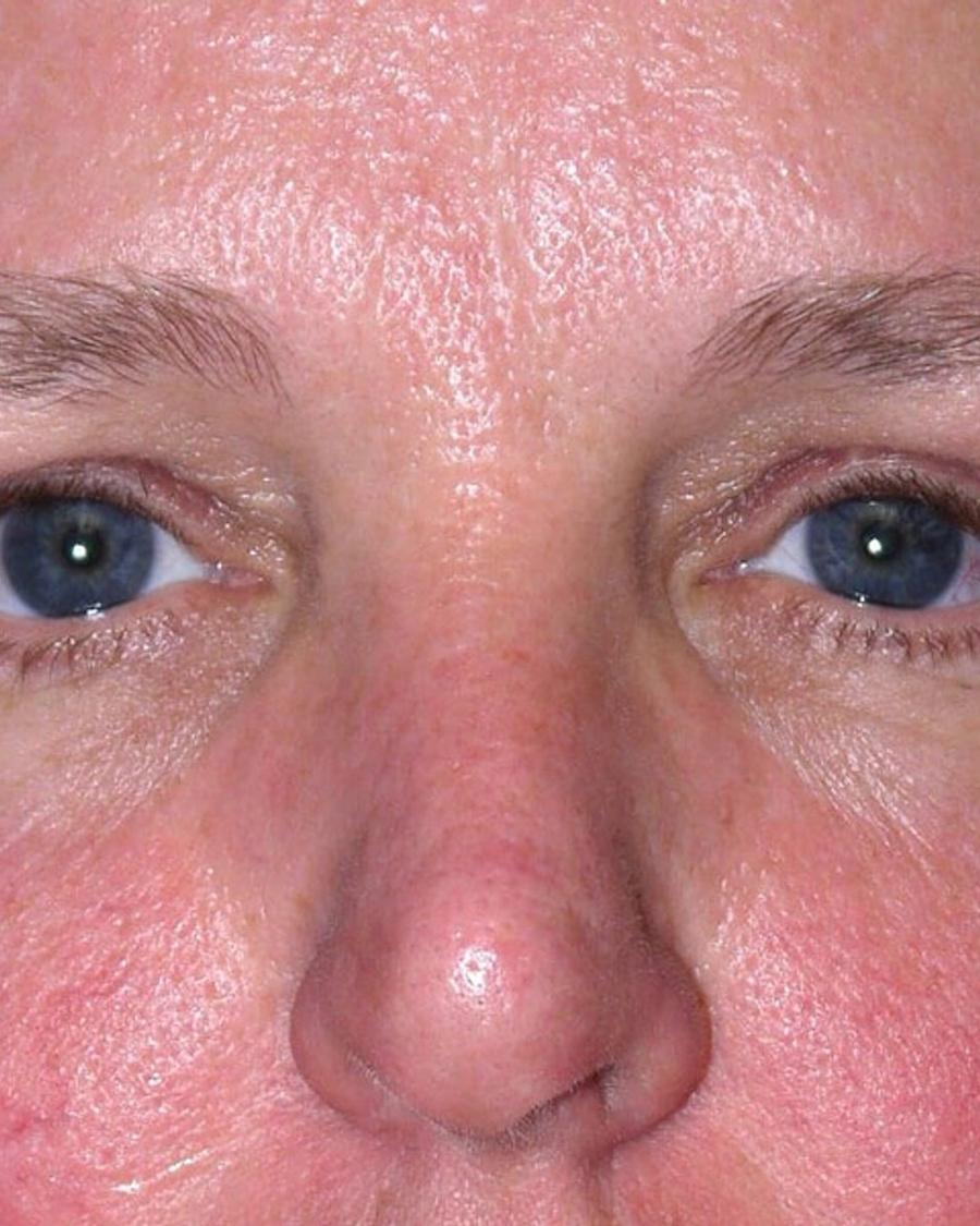 Facelift (neck lift included) after