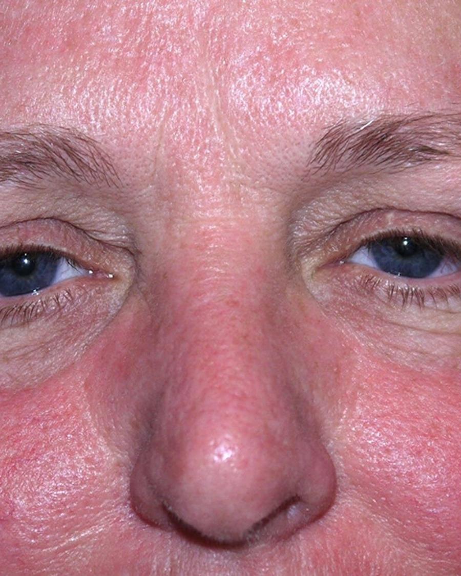 Facelift (neck lift included) before