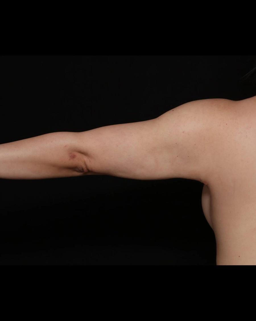 Arm Lift, Back view, after