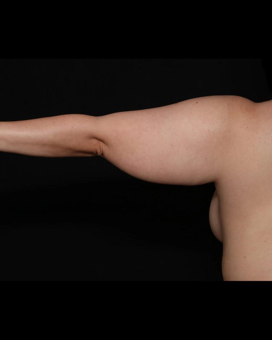 Arm Lift, Back view, before