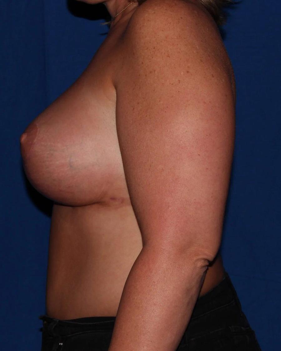 Breast Augmentation with Implants, Right Profile view, after