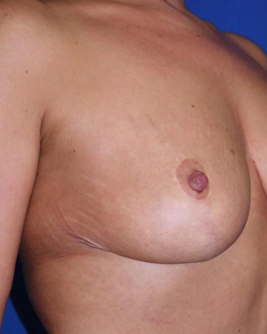 Breast Reduction after