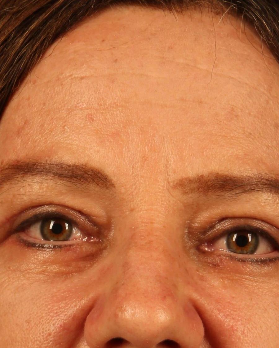 Eyelid Surgery after