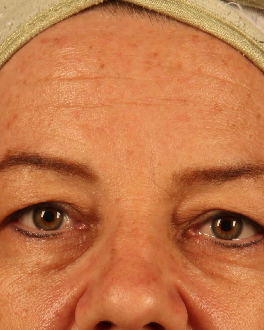 Eyelid Surgery before