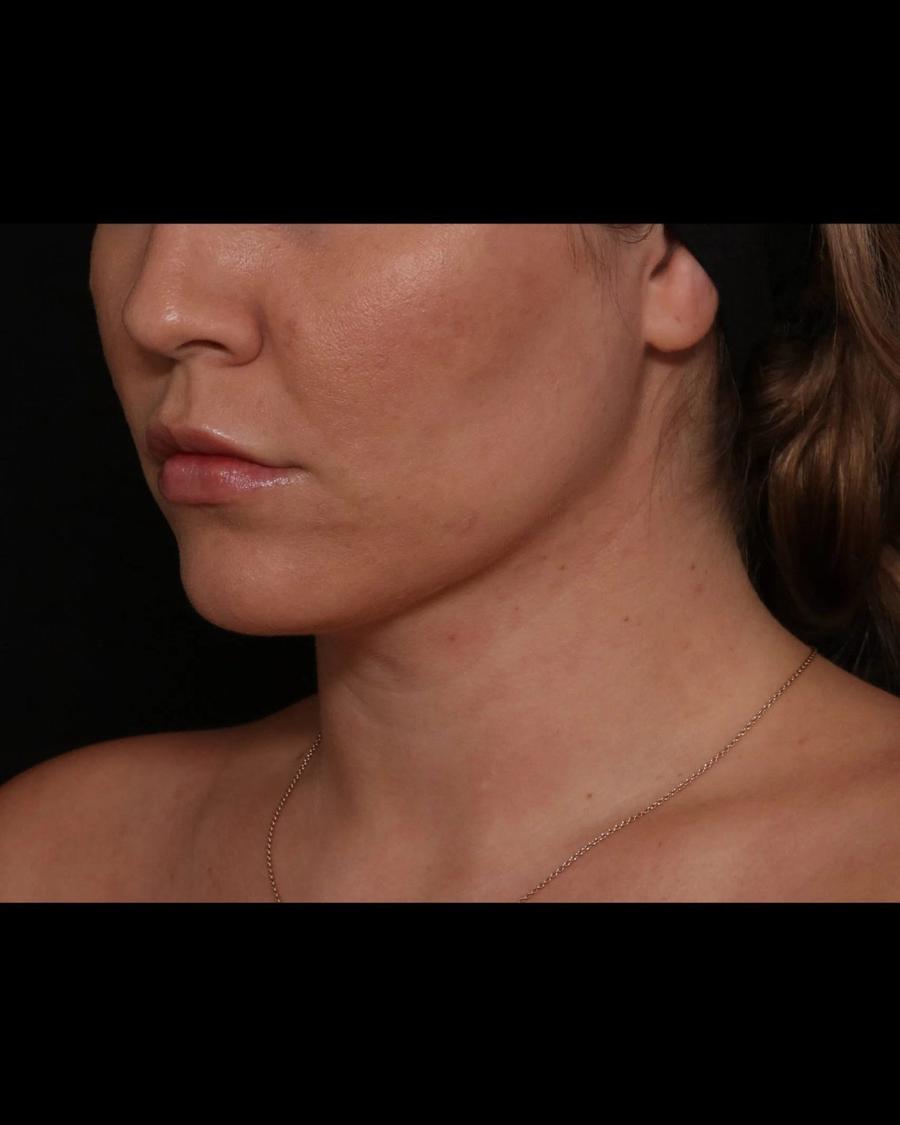 Neck Liposuction w/ Magic Tight, Oblique Right view, after