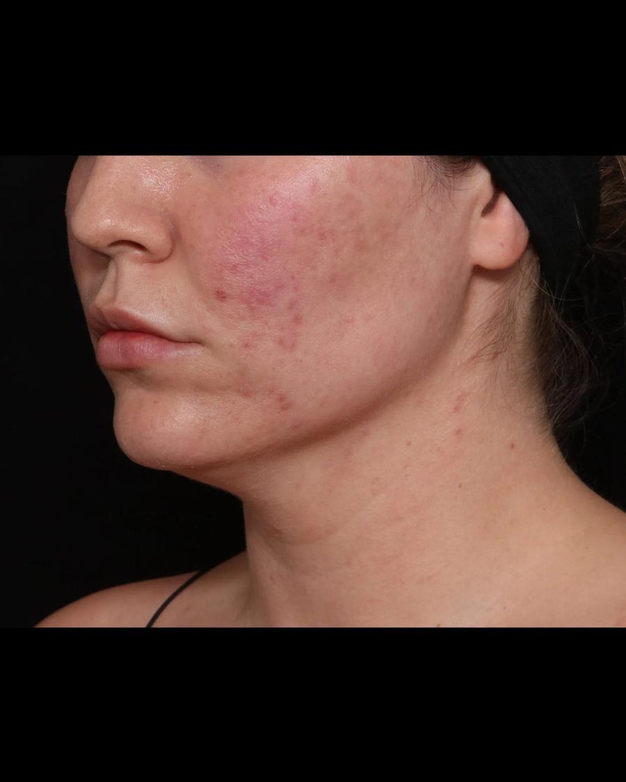 Neck Liposuction w/ Magic Tight, Oblique Right view, before