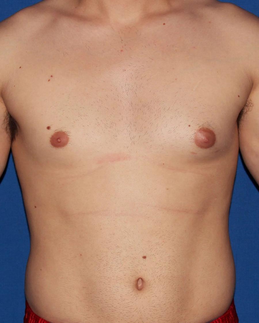 One-Stitch Gynecomastia before