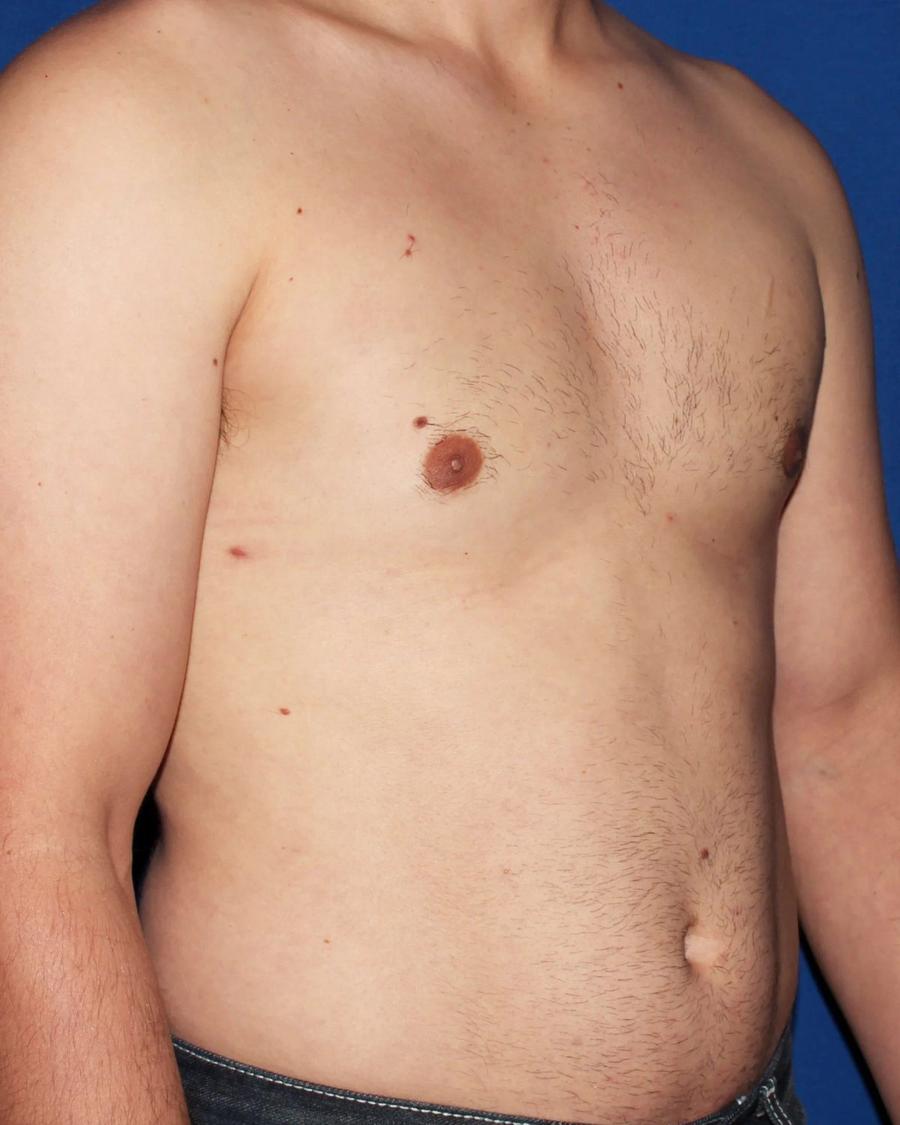 One-Stitch Gynecomastia, Oblique Right view, after