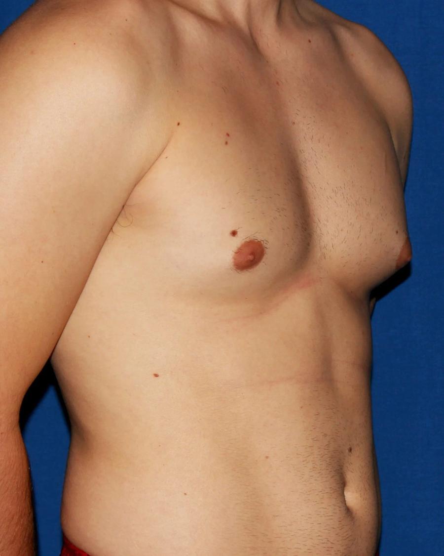 One-Stitch Gynecomastia, Oblique Right view, before