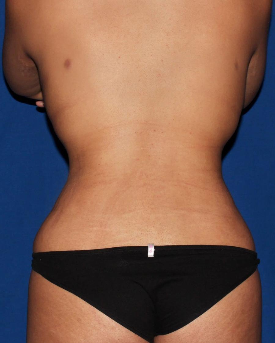 Front Liposuction (5L) (Same As Lipo360), Back view, after