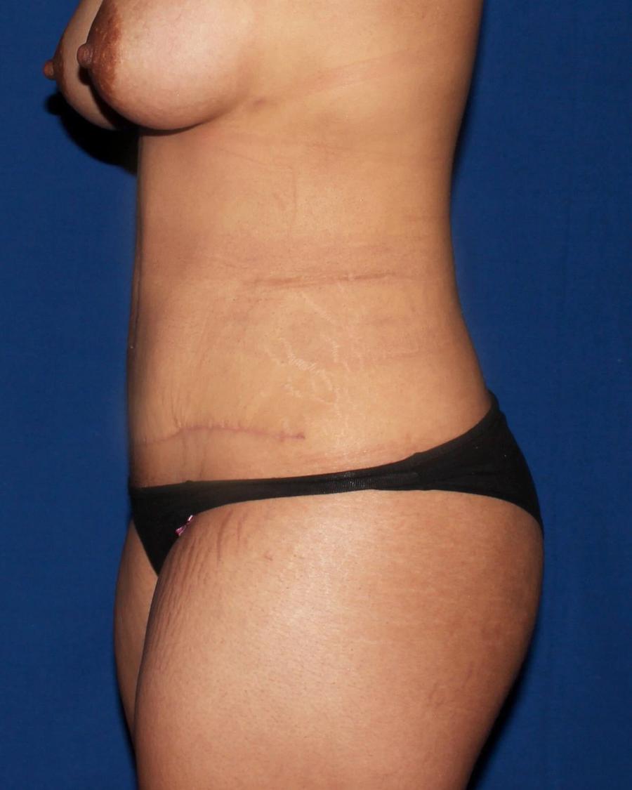 Front Liposuction (5L) (Same As Lipo360), Right Profile view, after