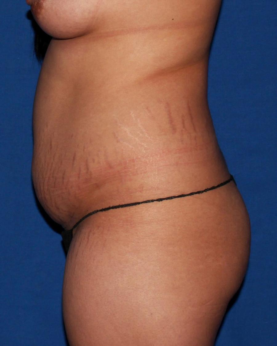 Front Liposuction (5L) (Same As Lipo360), Right Profile view, before