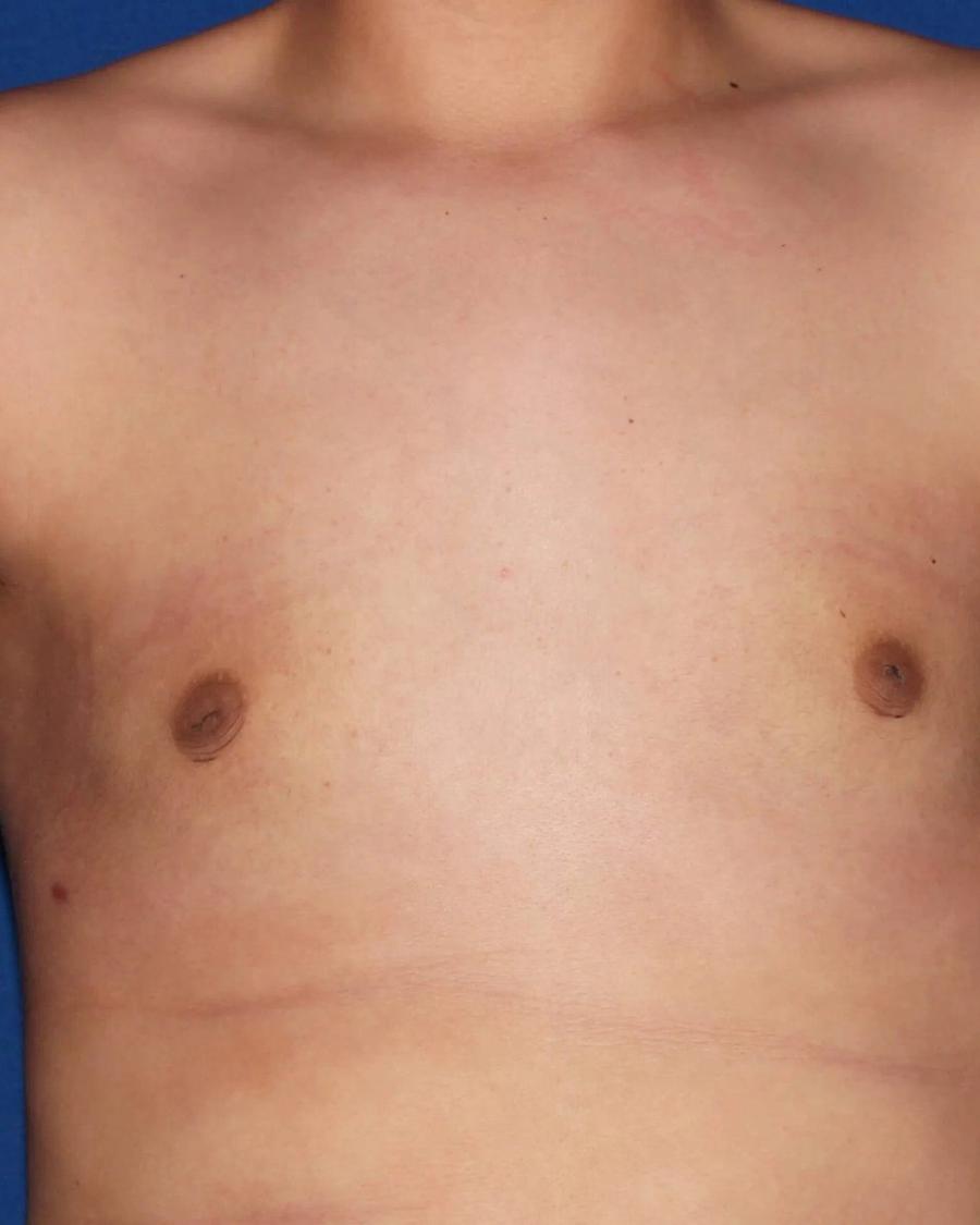 One-Stitch Gynecomastia after