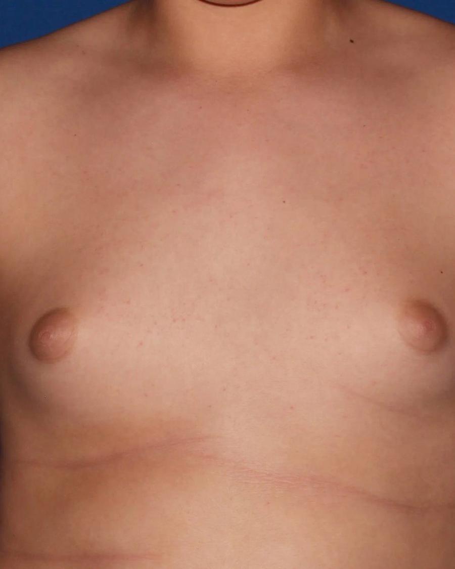 One-Stitch Gynecomastia before