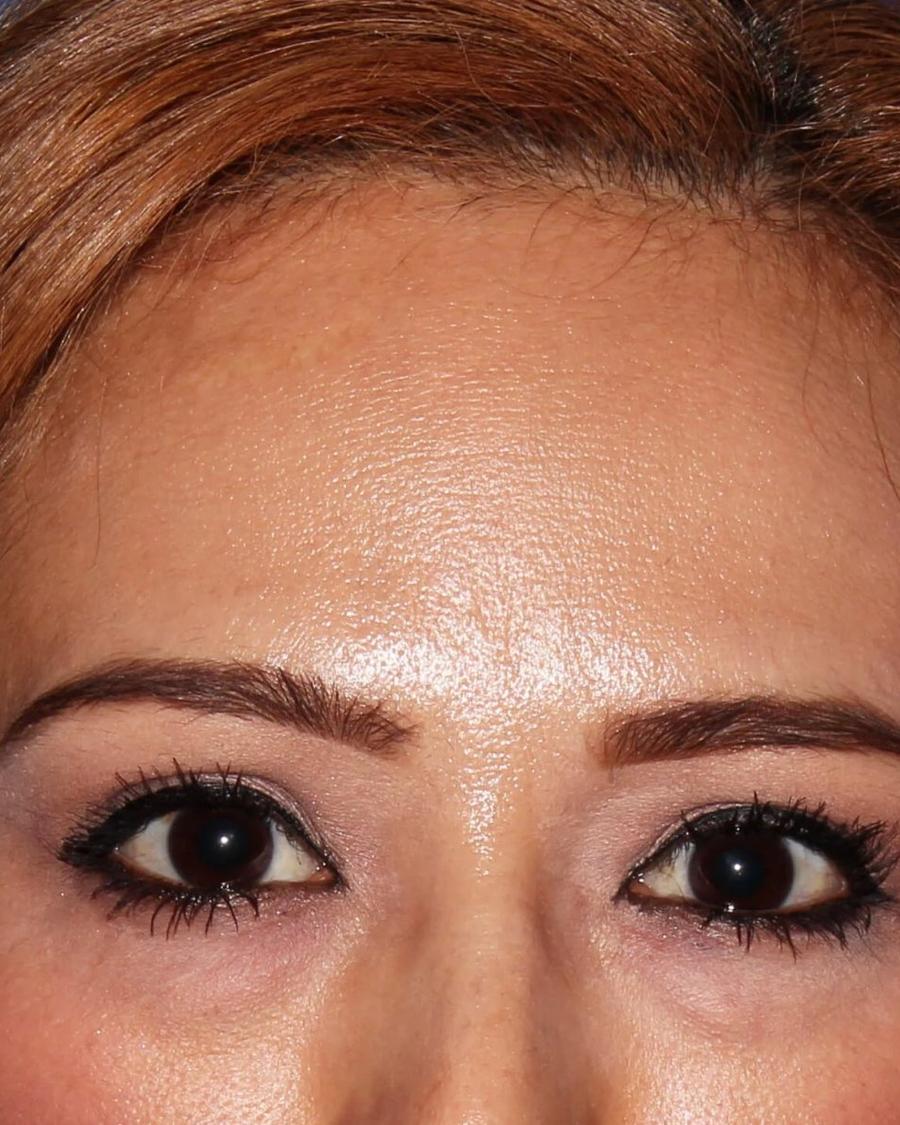 Eyelid Surgery before