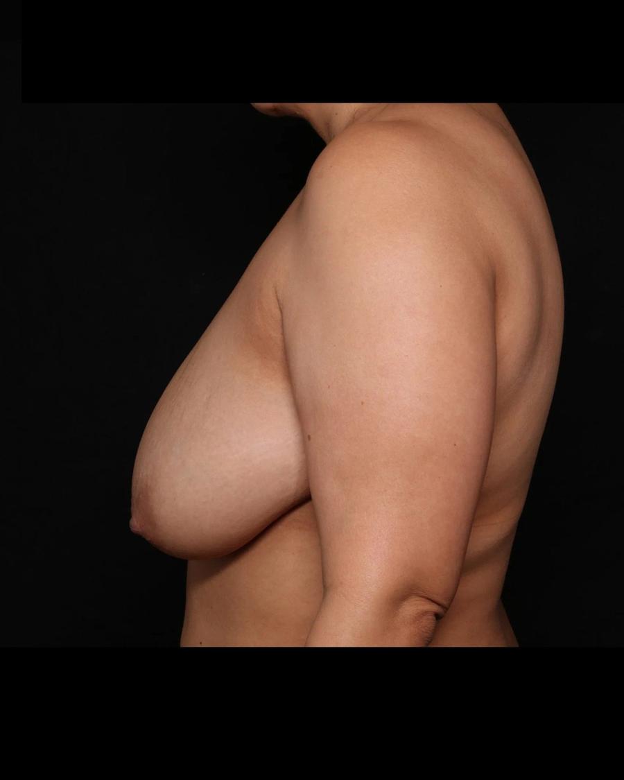 Breast Reduction, Right Profile view, before