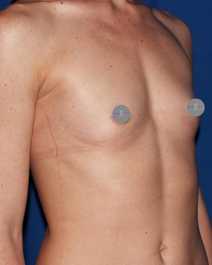 Breast Augmentation with Implants, Oblique Right view, before