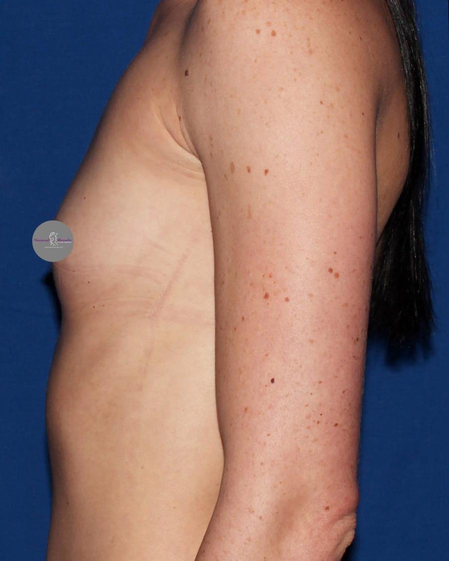 Breast Augmentation with Implants, Right Profile view, before