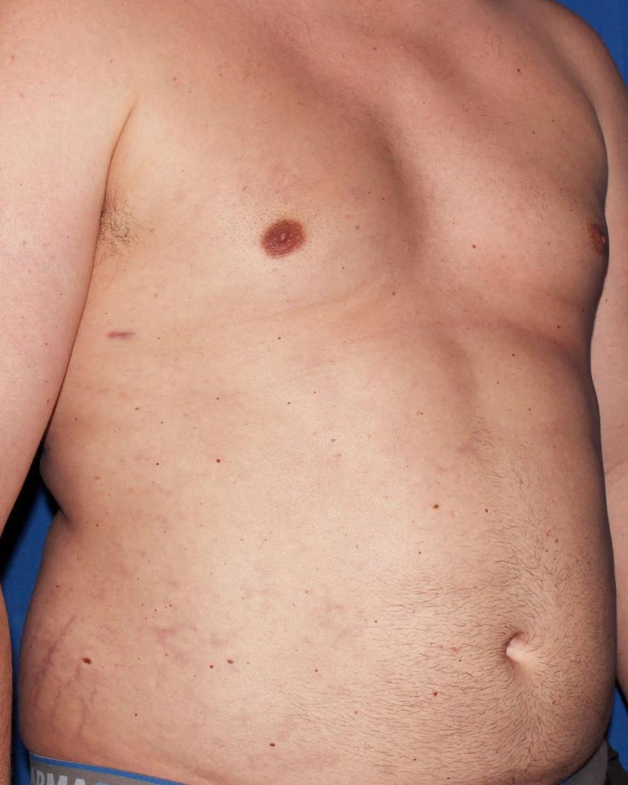 One-Stitch Gynecomastia after