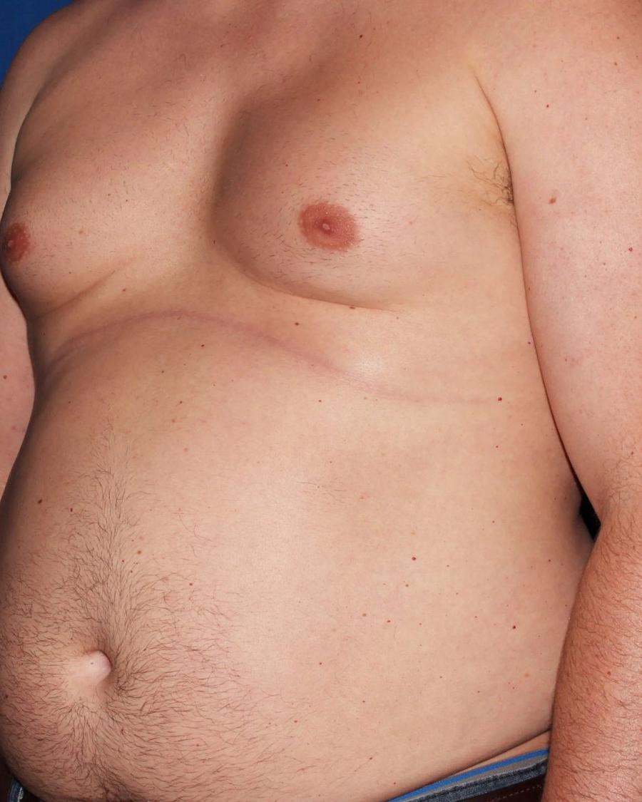 One-Stitch Gynecomastia before