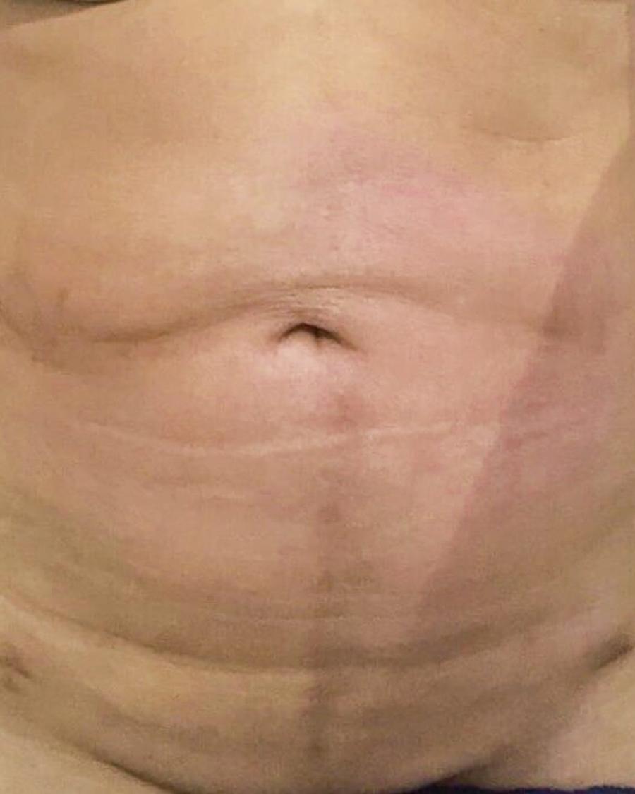 Front Liposuction (5L) (Same As Lipo360) after