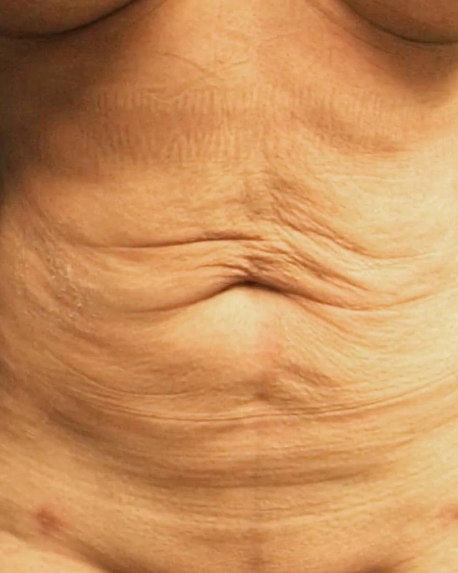 Front Liposuction (5L) (Same As Lipo360) before