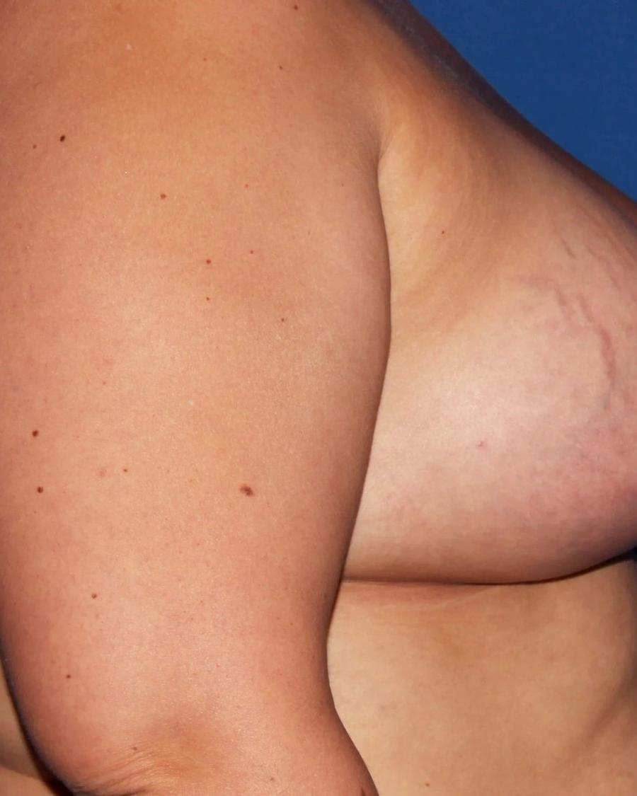 Breast Augmentation with Implants, Right Profile view, after