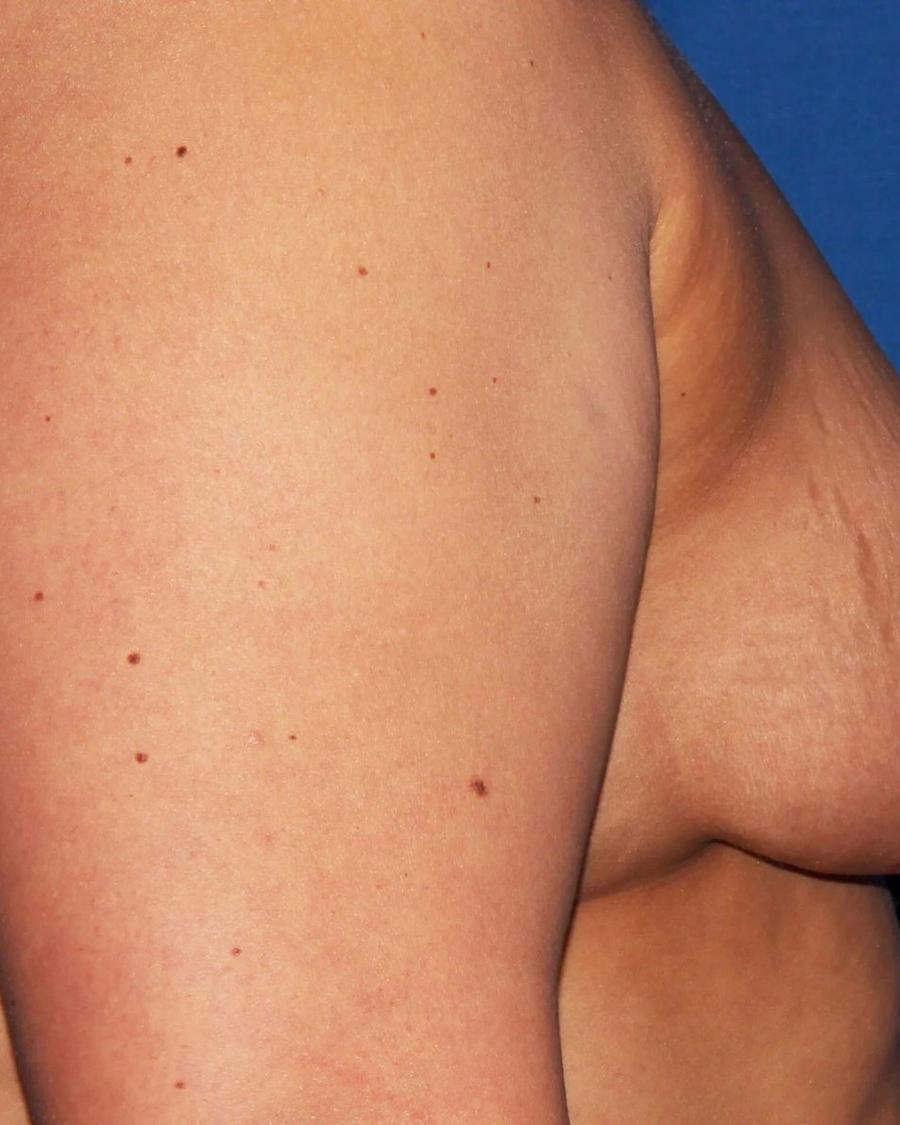 Breast Augmentation with Implants, Right Profile view, before