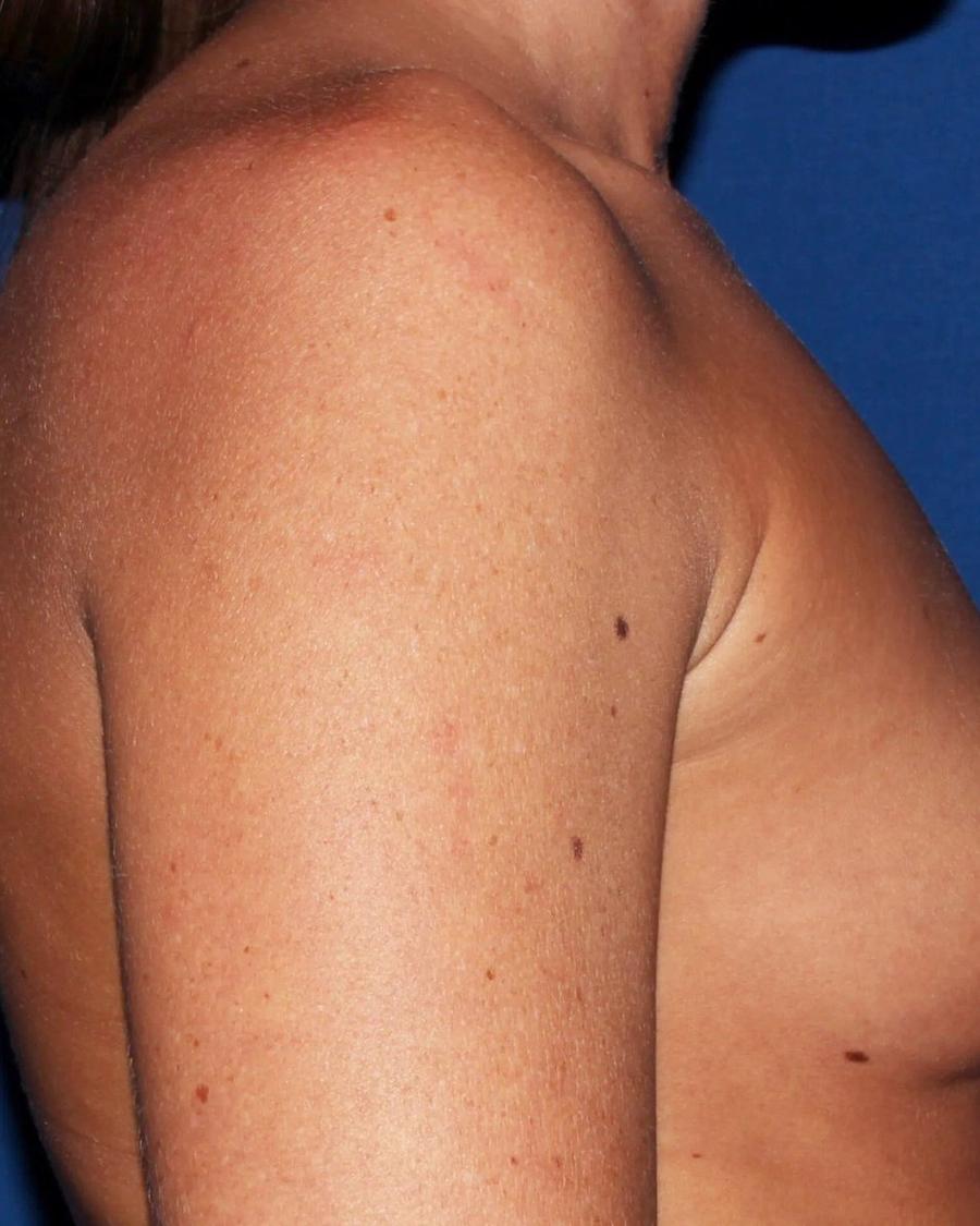 Breast Augmentation with Implants, Right Profile view, before