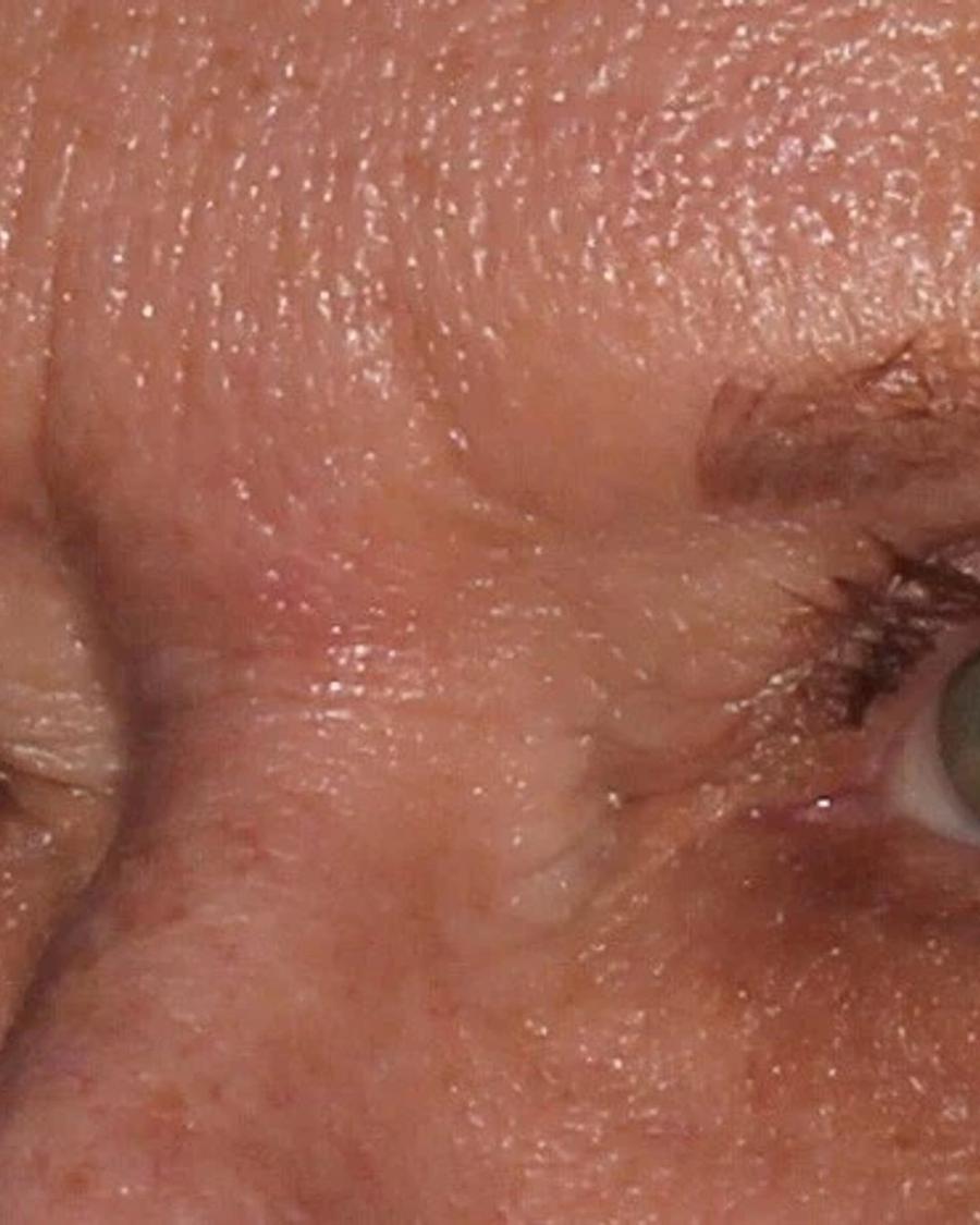 After Eyelid Surgery