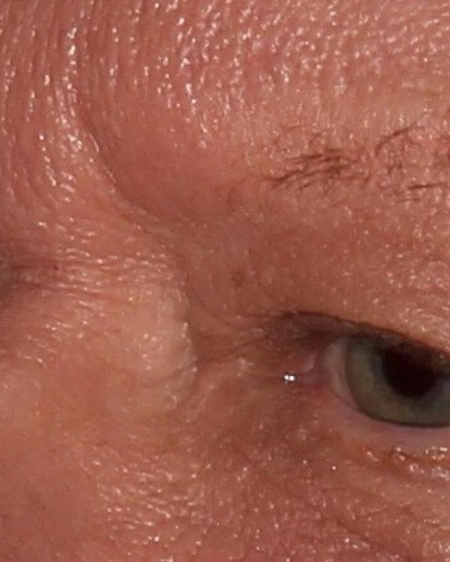 Before Eyelid Surgery