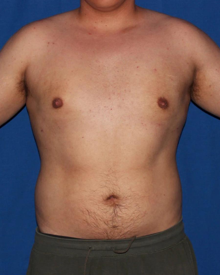 One-Stitch Gynecomastia after