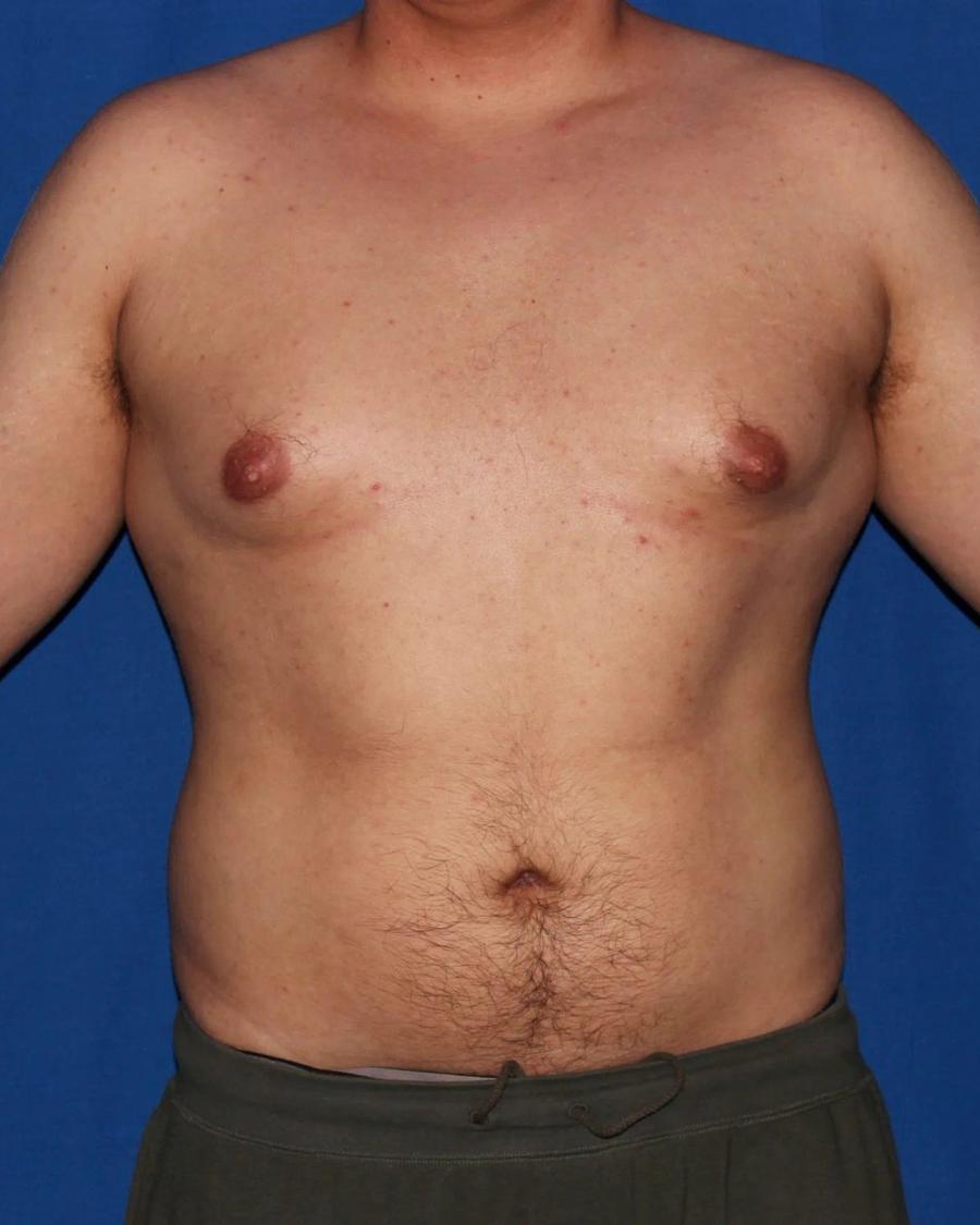 One-Stitch Gynecomastia before