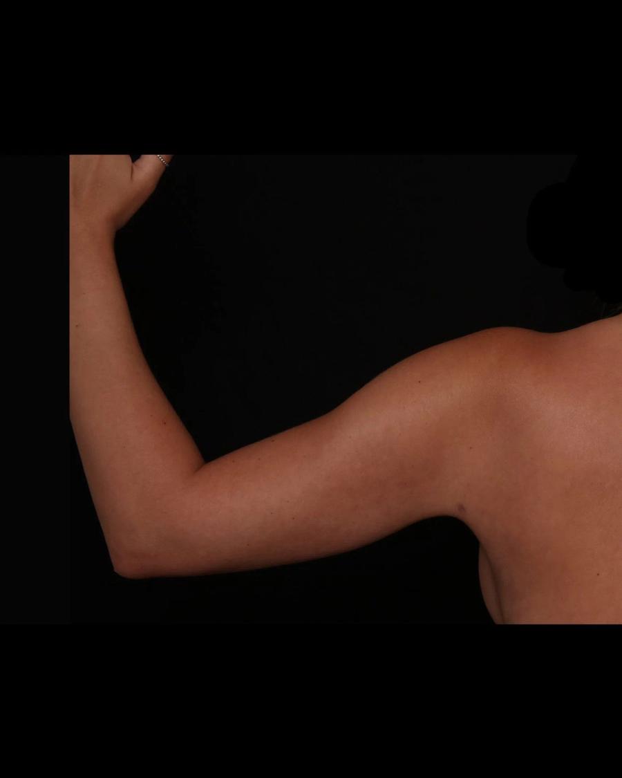 Arm Lift, Back view, after