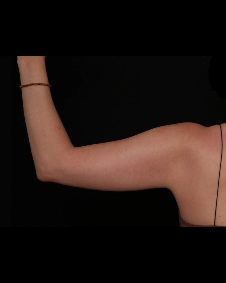 Arm Lift, Back view, before