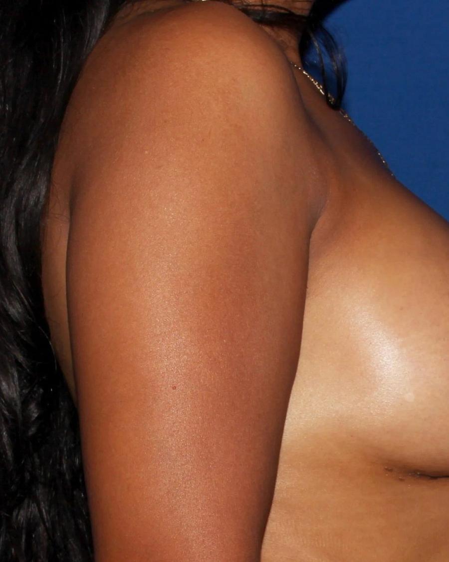 Breast Augmentation with Implants after