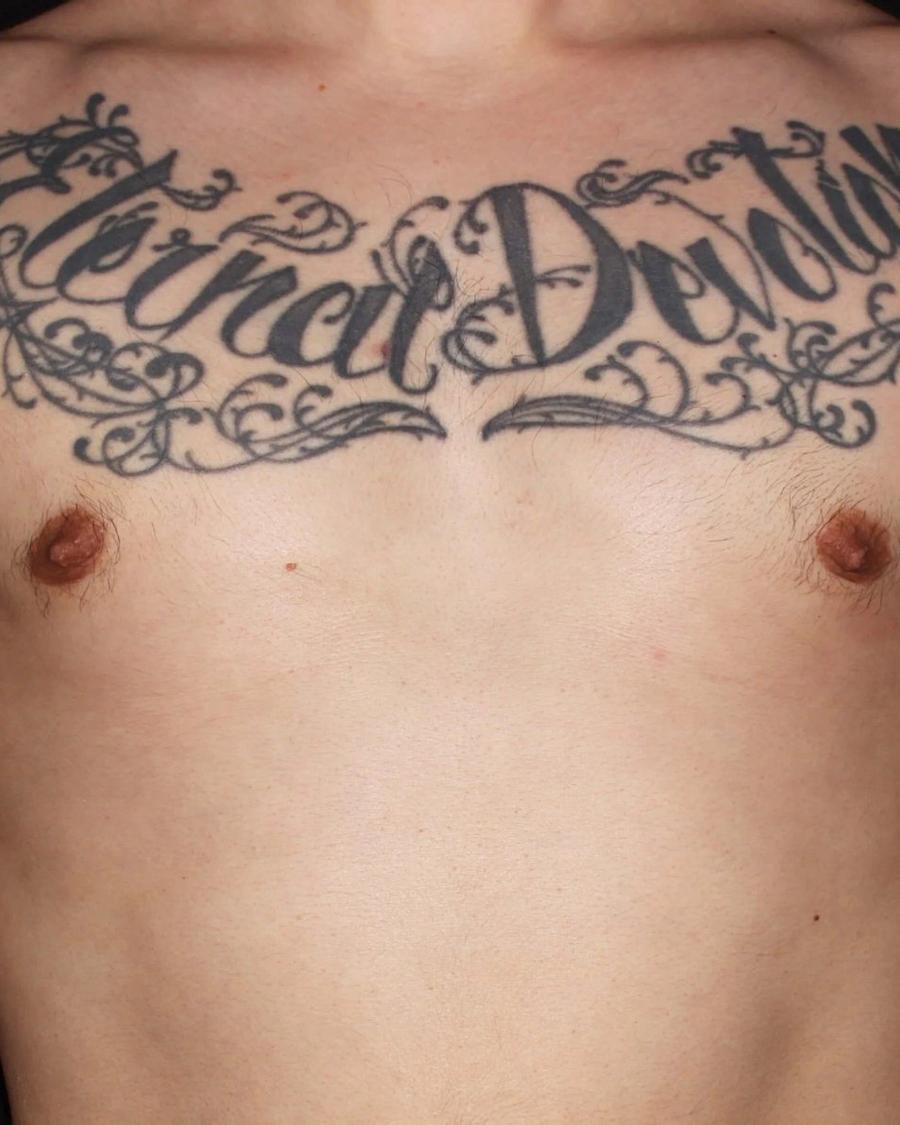 One-Stitch Gynecomastia after