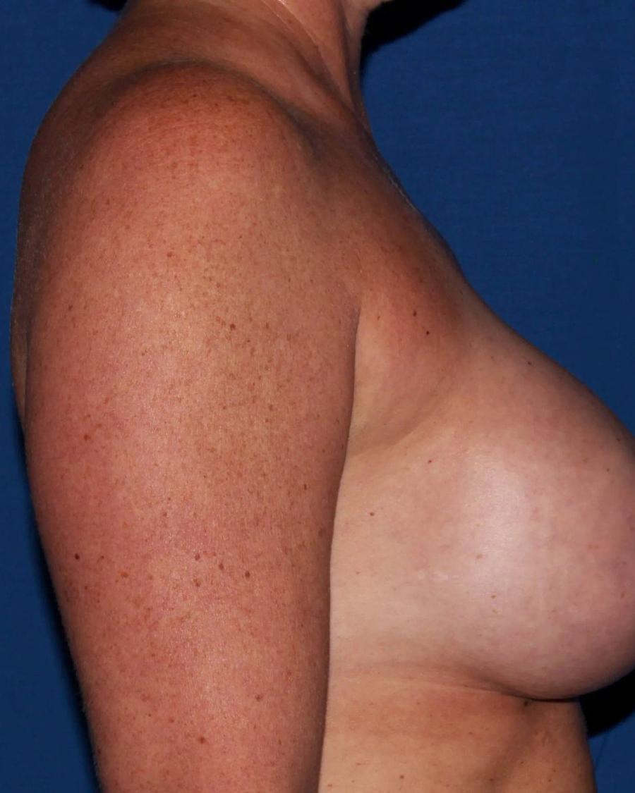 Breast Augmentation with Implants, Oblique Right view, after