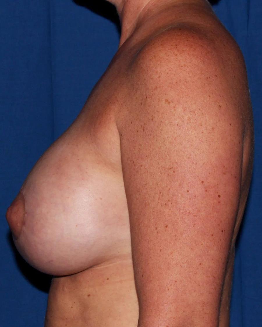 Breast Augmentation with Implants after