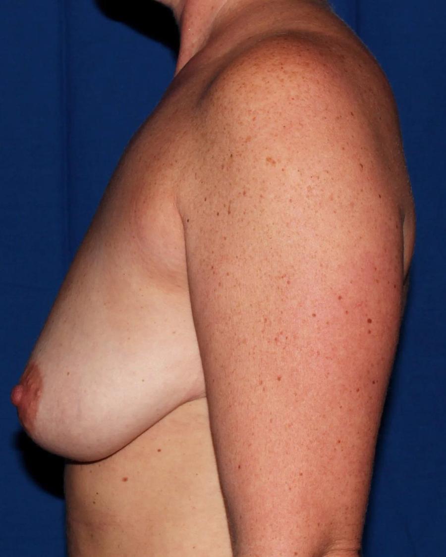 Breast Augmentation with Implants before