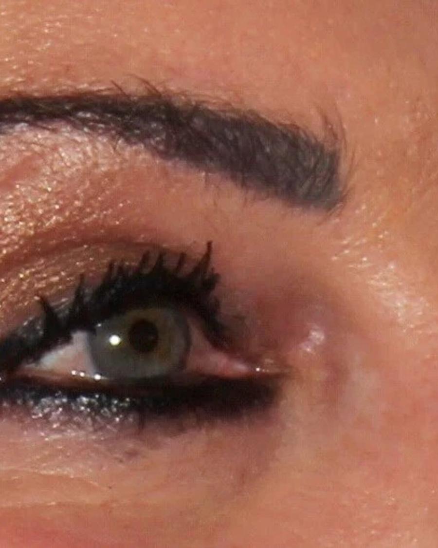 Eyelid Surgery after
