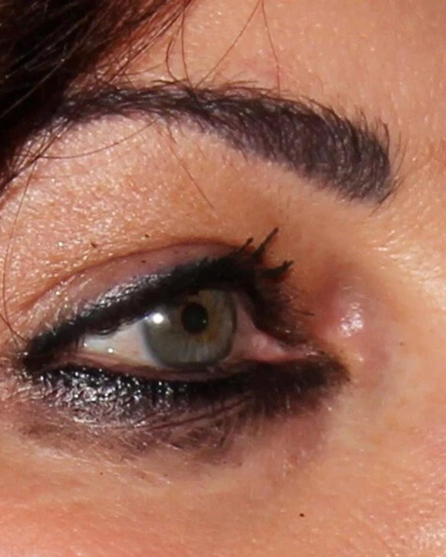 Eyelid Surgery before