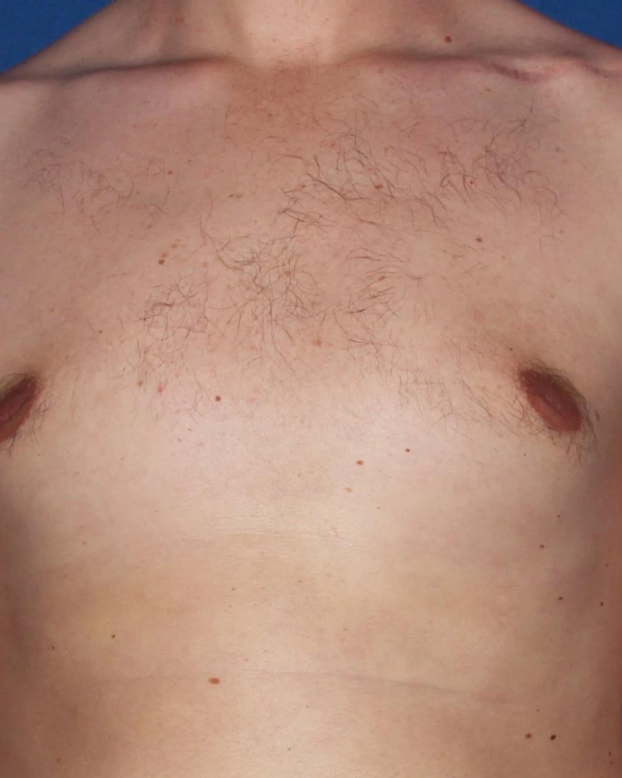 One-Stitch Gynecomastia after