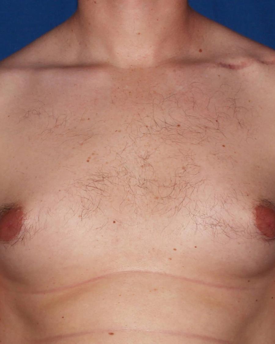 One-Stitch Gynecomastia before