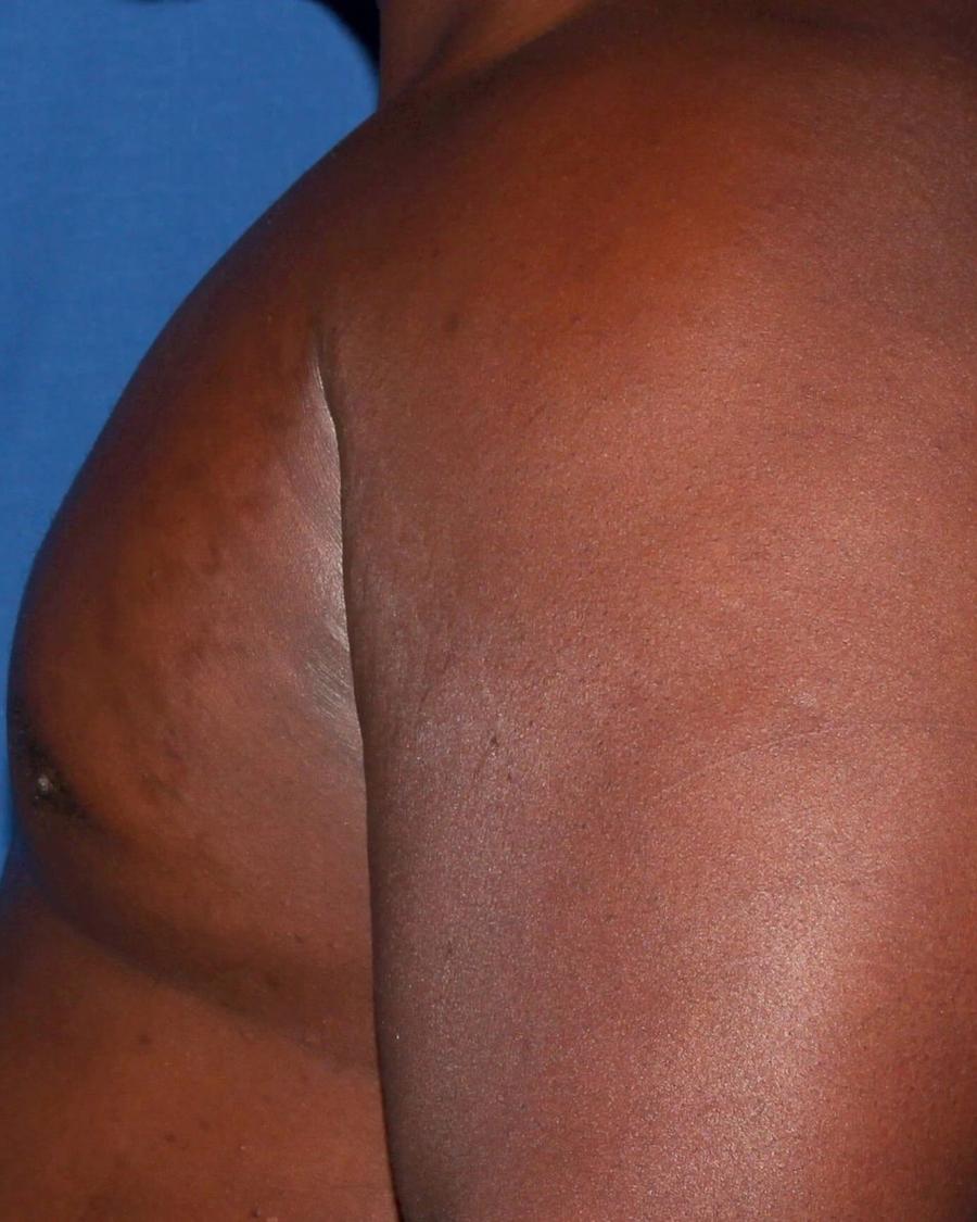 One-Stitch Gynecomastia after