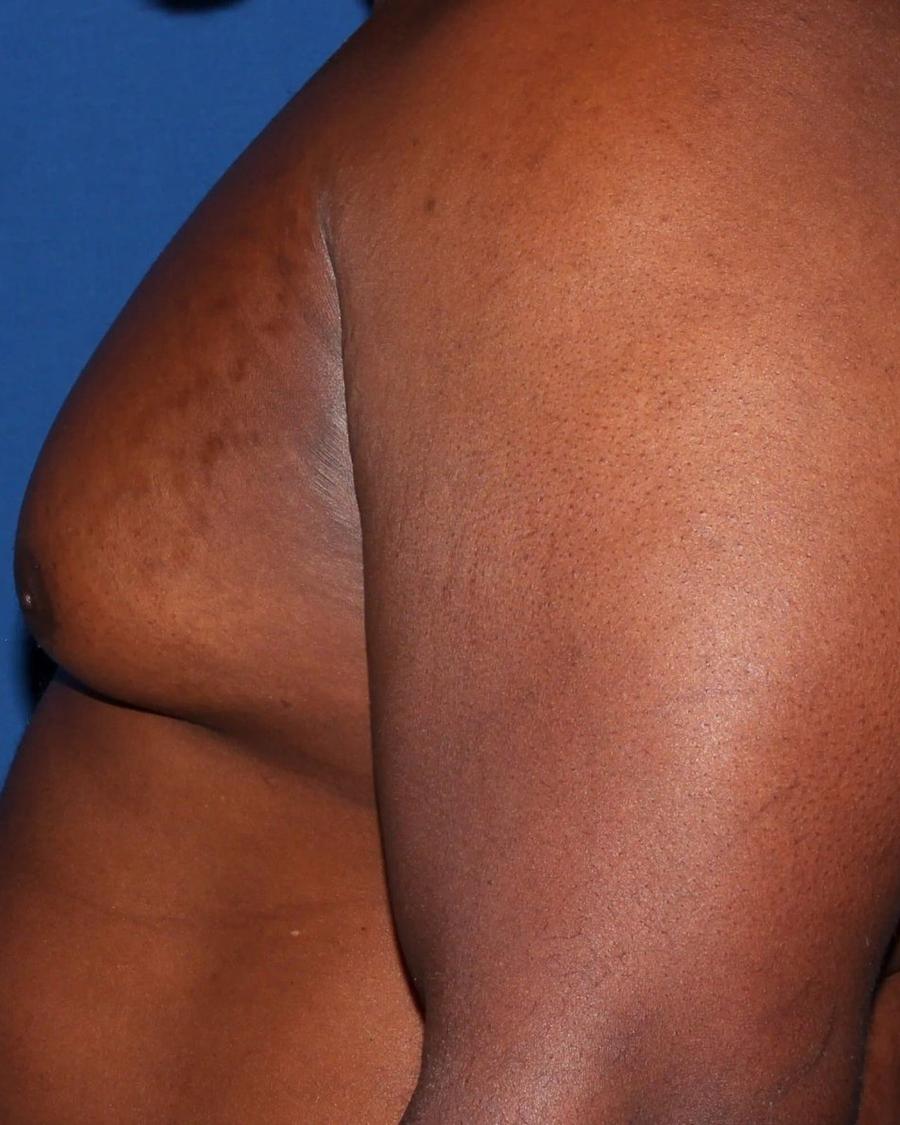 One-Stitch Gynecomastia before
